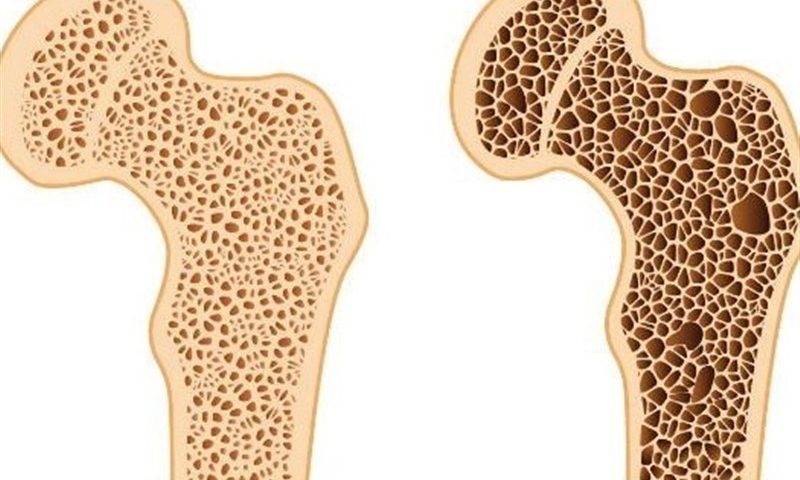 بهترین روش تشخیص پوکی استخوان/ دلایل ابتلا به بیماری